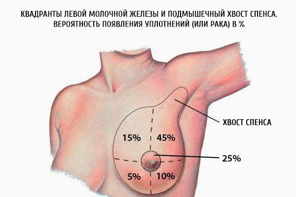 Kvadranty levého prsu a axilární spence spence.  Pravděpodobnost tuleňů (nebo rakoviny) v%