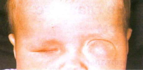 Mikroftalmus se souběžnou tvorbou cyst (levé oko).  Anophthalmus (pravé oko).
