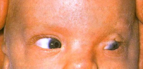 Fraserův syndrom.  Neúplný kryptophthalmos levého oka.