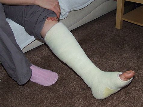 Opatření doma s zlomenou nohou