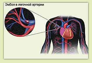 Plicní embolie a bolesti na hrudi vlevo